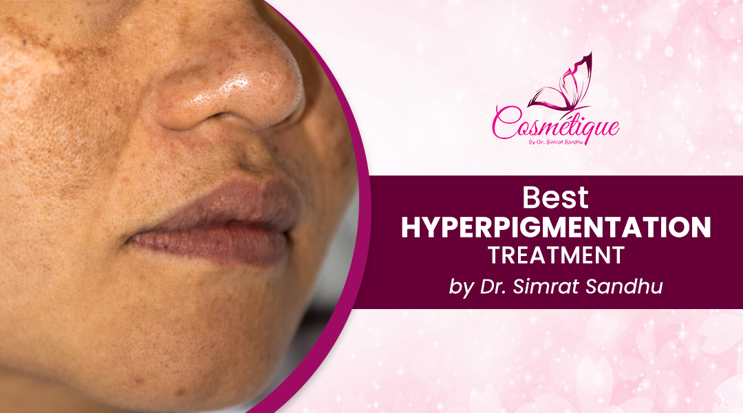 Best Hyperpigmentation Treatment by Dr. Simrat Sandhu